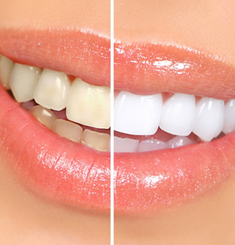 ابتسامة هوليود