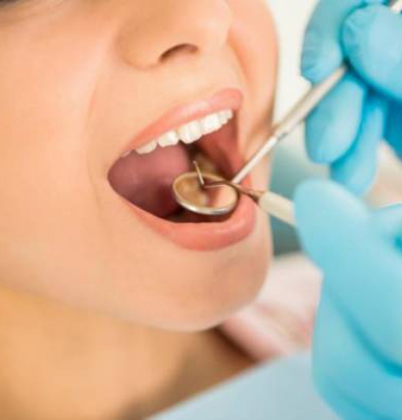 ملء الأسنان