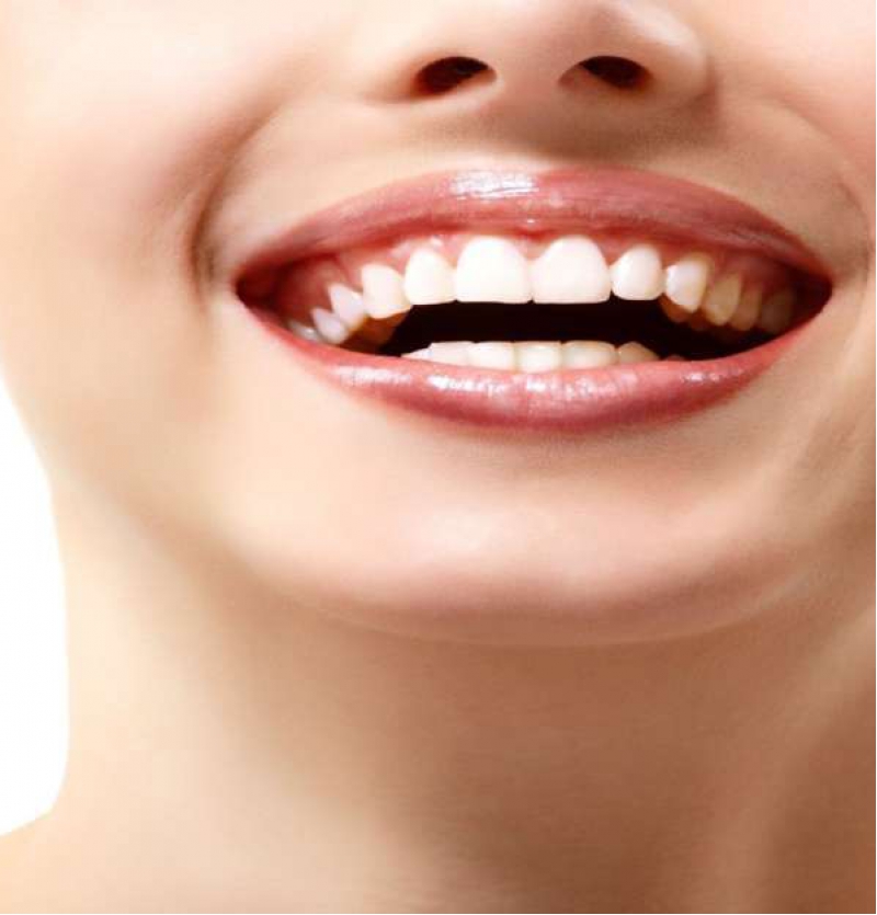 ابتسامة هوليود أو القشرة الاسنان