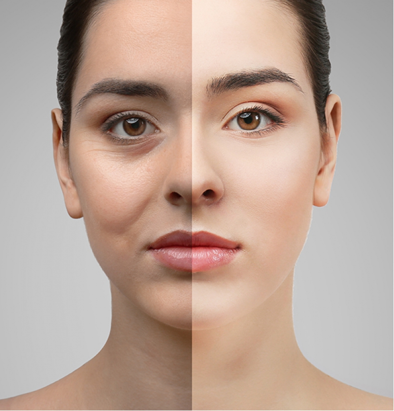 جراحة تجميل الجفن العلوى