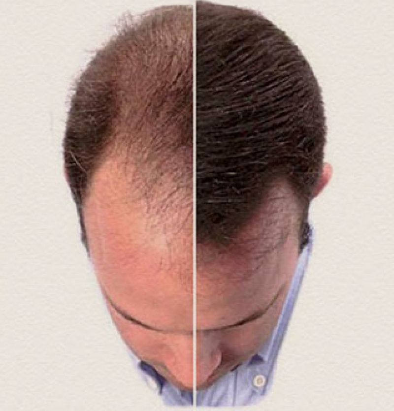 زراعة الشعر فی ایران